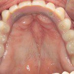 Prótese fixa sobre implantes