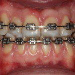 Oclusão frontal depois