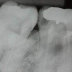Dente 38 erupcionado, com raiz já formada