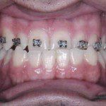 Oclusão frontal antes