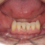 Desdentado bilateral inferior