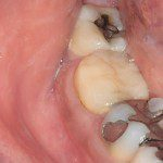 Vista oclusal - 4 anos após