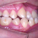 Oclusão lateral antes