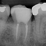 Radiografia - 4 anos após