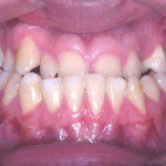 Oclusão frontal antes