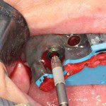 Instalação guiada do implante