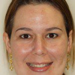 Daniela - Face depois