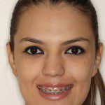 Jennifer - Face depois