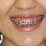 Jennifer - Meia face antes