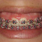 Jennifer - Sorriso antes