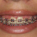 Jennifer - Sorriso depois